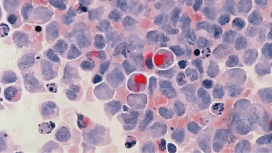 EBC-46: A Potential Natural Ally in Cancer Treatment – Blushwood Health